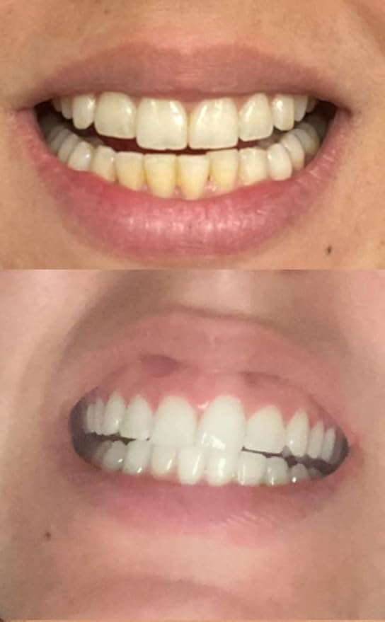 Teeth Whitening Kit with LED Light, 3 Carbamide Peroxide Teeth Whitening Gel Express Teeth Whitener. Remove Stains from Coffee, Smoking, Wine, Food (5 Piece Set)