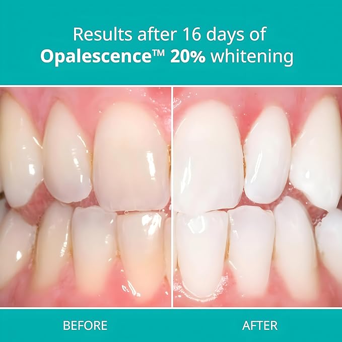 Opalescence 35% with PF Gel Syringes Teeth Whitening - (8 Syringes) Refill Kit Carbamide Peroxide. Made by Ultradent, in Melon Flavor. Tooth Whitening Refill Syringes 5404-4