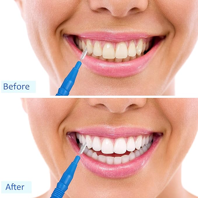 BBTO 100 Pcs Braces Dental Brush Flosser for Cleaner Interdental Brush Toothpick Tooth Flossing Head Oral Dental Toothpick Cleaners Cleaning Tool(Red, Blue, White and Green)